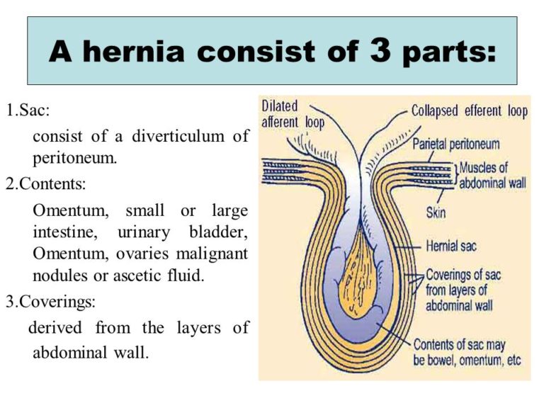 hernia-remediation-coaching-letter-session-4-holistic-hernia