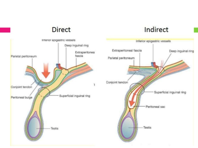 Anatomy Of A Hernia – Holistic Hernia Remediation