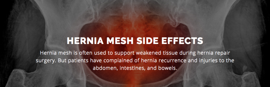 HERNIA MESH SIDE EFFECTS Holistic Hernia Remediation