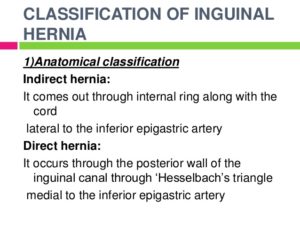 ANATOMY Of A HERNIA – Holistic Hernia Remediation