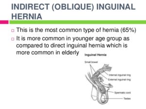 ANATOMY Of A HERNIA – Holistic Hernia Remediation